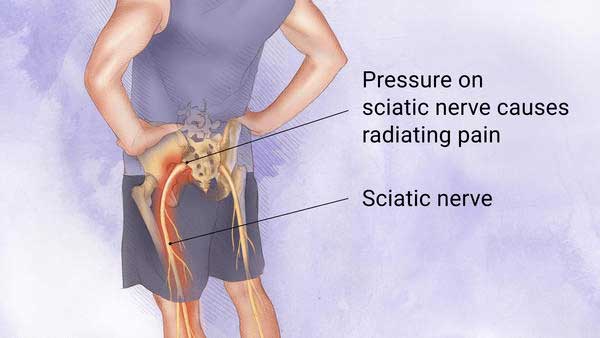 Illustration of a chiropractor relieving pressure on the sciatic nerve through spinal adjustment
