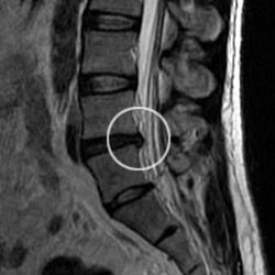 MRI image of the lumbar spine showing a disc herniation compressing the sciatic nerve