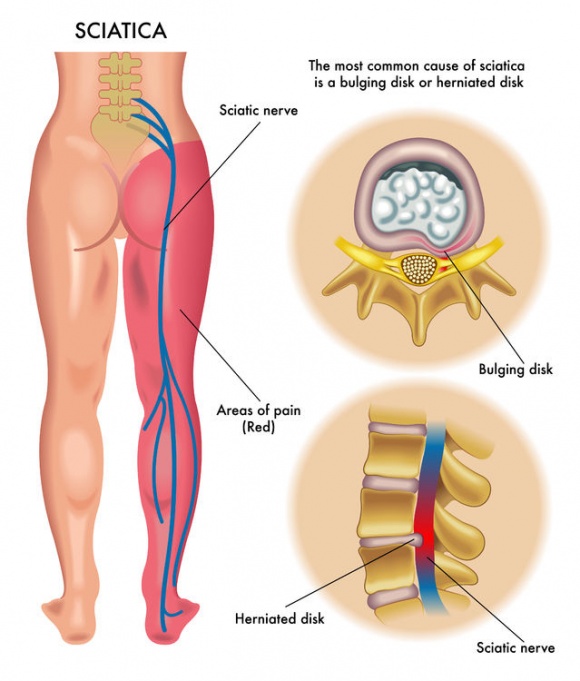 Diagram showing the sciatic nerve pathway and common areas of compression causing sciatica pain